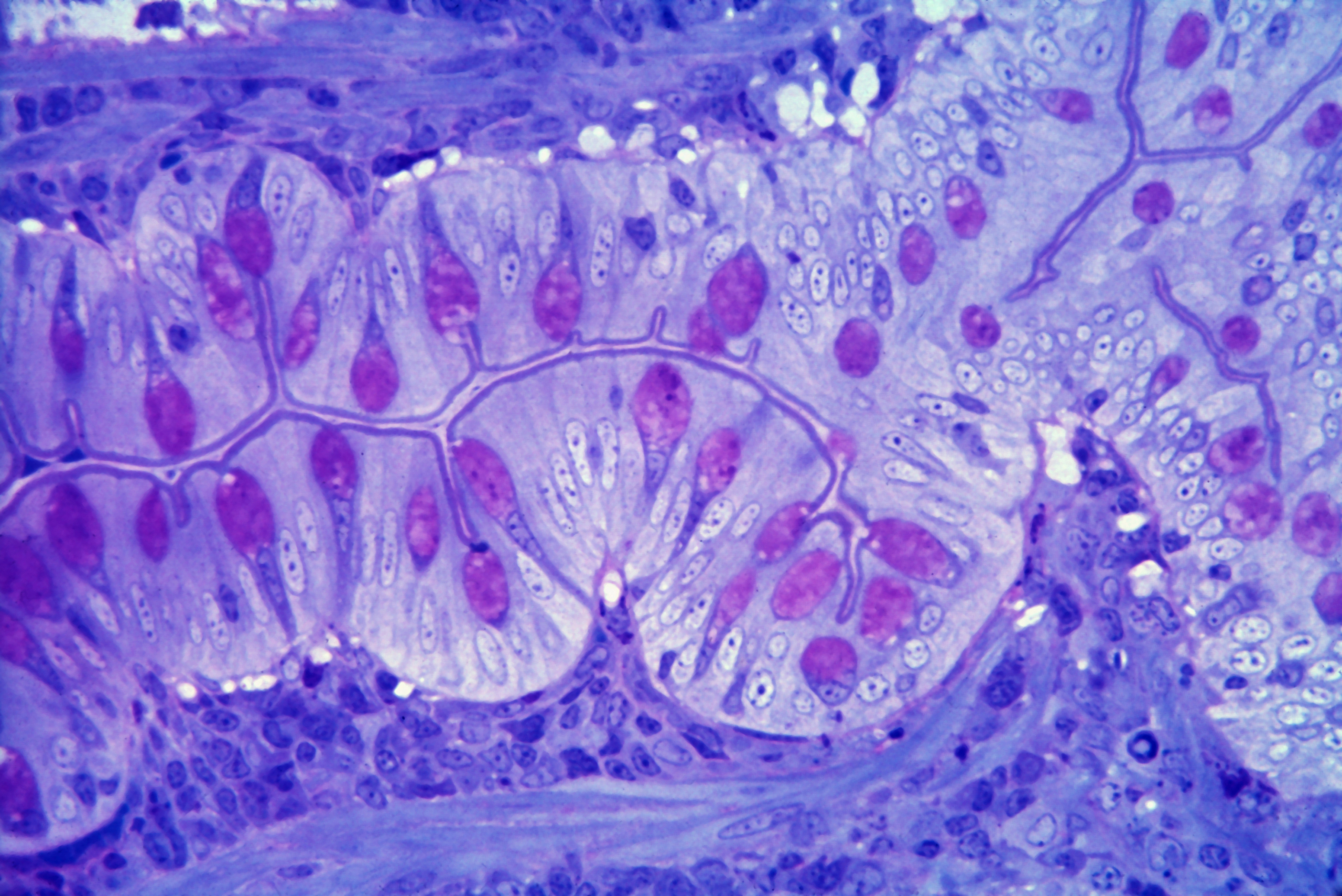 Could Statins Treat Stricturing Crohn’s Disease?
